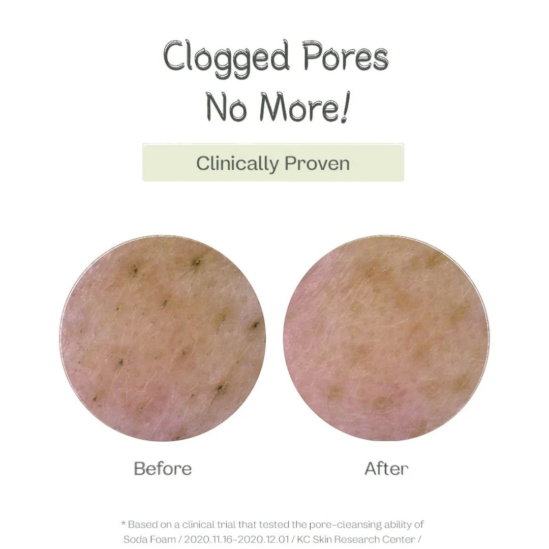 ma:nyo Purifying Cleansing Soda Foam 150ml before and after showing unclogged pores effects.